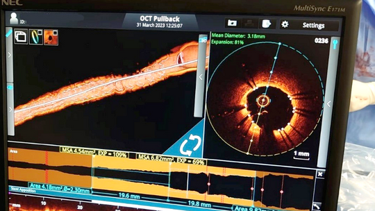 Kolejne nowoczesne technologie w oddziale kardiologii łomżyńskiego szpitala