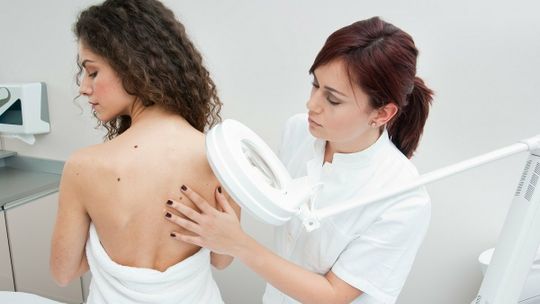 Pieprzyki i znamiona. Badaj je regularnie