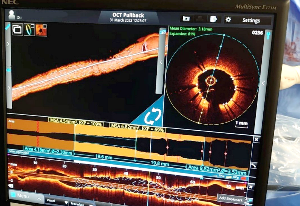 Kolejne nowoczesne technologie w oddziale kardiologii łomżyńskiego szpitala